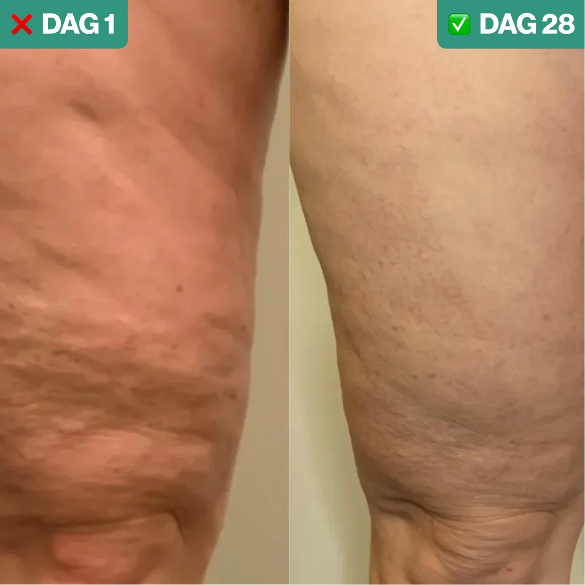 BodyLiftPro™ | Cellulitis Verwijderaar & Huidversteviger