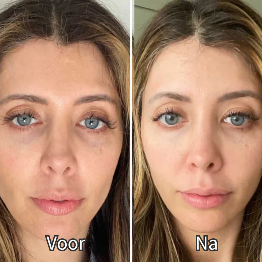 EyeShine™ | Rood Licht & EMS | Vermindert donkere kringen onder de ogen.