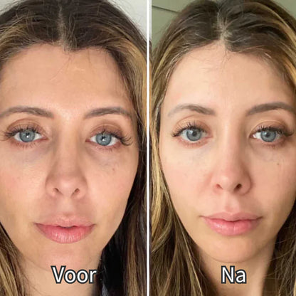 EyeShine™ | Rood Licht & EMS | Vermindert donkere kringen onder de ogen.